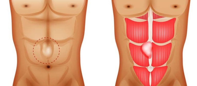 Hérnias da Parede Abdominal Clínica Cirúrgica Dr Guilherme Cotta